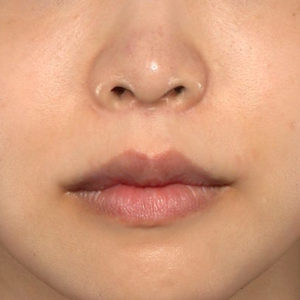 新宿ラクル美容外科クリニック　山本厚志　「人中短縮術（リップリフト）＋口角挙上（スマイルリップ）」　手術後６ヶ月目　１２月２１日