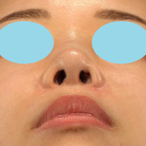 新宿ラクル美容外科クリニック　山本厚志　「鼻孔縁下降術」　手術前　８月５日