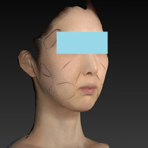 新宿ラクル美容外科クリニック　山本厚志　ナチュラルフェイスリフト　デザイン　８月２０日