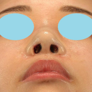 新宿ラクル美容外科クリニック　山本厚志　「鼻孔縁下降術」　手術直後　８月５日