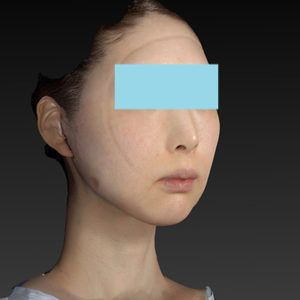 新宿ラクル美容外科クリニック　山本厚志　ナチュラルフェイスリフト　手術直後　８月２０日