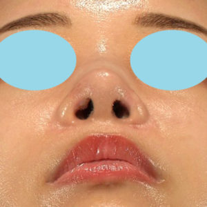 新宿ラクル美容外科クリニック　山本厚志　「鼻孔縁下降術」　手術後１週間目　８月５日