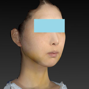 新宿ラクル美容外科クリニック　山本厚志　ナチュラルフェイスリフト　手術後１週間目　８月２０日