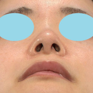 新宿ラクル美容外科クリニック　山本厚志　「小鼻縮小+α法」　手術後１２ヶ月目　１月２３日