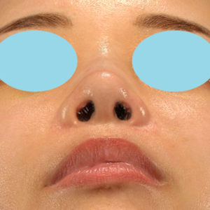 手術後1ヶ月目 新宿ラクル美容外科クリニック 山本厚志 「鼻孔縁下降術」 手術後1ヶ月目 8月5日