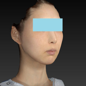 新宿ラクル美容外科クリニック　山本厚志　ナチュラルフェイスリフト　手術後１ヶ月目　８月２０日