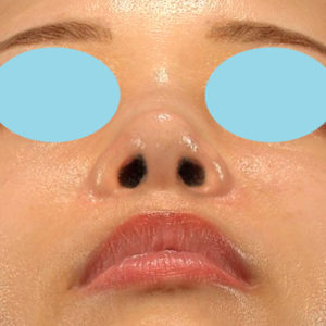 新宿ラクル美容外科クリニック　山本厚志　「鼻孔縁下降術」　手術後２ヶ月目　８月５日