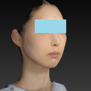 新宿ラクル美容外科クリニック　山本厚志　ナチュラルフェイスリフト　手術後３ヶ月目　８月２０日