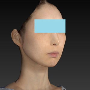 新宿ラクル美容外科クリニック　山本厚志　ナチュラルフェイスリフト　手術後６ヶ月目　１１月１１日