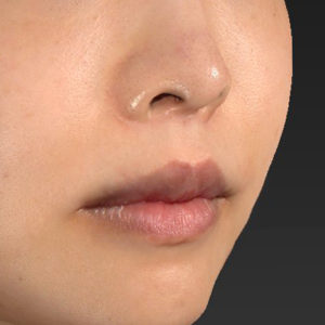 新宿ラクル美容外科クリニック　山本厚志　「人中短縮術（リップリフト）＋口角挙上（スマイルリップ）」　手術後６ヶ月目　１２月２１日