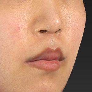 新宿ラクル美容外科クリニック　山本厚志　「人中短縮術（リップリフト）＋口角挙上（スマイルリップ）」　手術後６ヶ月目　１月１日