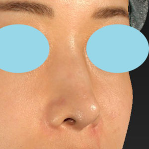 新宿ラクル美容外科クリニック　山本厚志　「鼻孔縁下降術」　手術前　８月５日