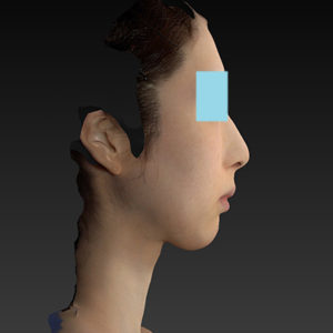 新宿ラクル美容外科クリニック　山本厚志　ナチュラルフェイスリフト　手術前　８月２０日