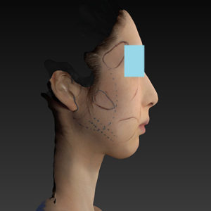 新宿ラクル美容外科クリニック　山本厚志　ナチュラルフェイスリフト　デザイン　８月２０日