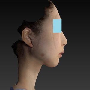 新宿ラクル美容外科クリニック　山本厚志　ナチュラルフェイスリフト　手術直後　８月２０日