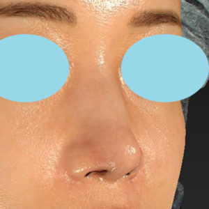 新宿ラクル美容外科クリニック　山本厚志　「鼻孔縁下降術」　手術後１週間目　８月５日