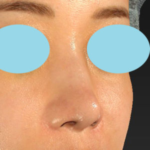 新宿ラクル美容外科クリニック　山本厚志　「鼻孔縁下降術」　手術後１ヶ月目　８月５日