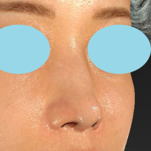 新宿ラクル美容外科クリニック　山本厚志　「鼻孔縁下降術」　手術後２ヶ月目　８月５日