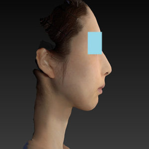 新宿ラクル美容外科クリニック　山本厚志　ナチュラルフェイスリフト　手術後２ヶ月目　８月２０日