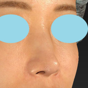 新宿ラクル美容外科クリニック　山本厚志　「鼻孔縁下降術」　手術後３ヶ月目　６月２５日