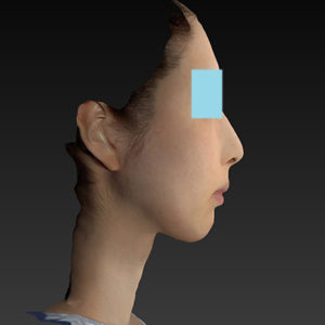 新宿ラクル美容外科クリニック　山本厚志　ナチュラルフェイスリフト　手術後３ヶ月目　８月２０日