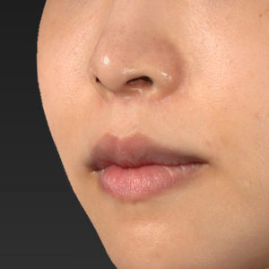手術後6ヶ月目 新宿ラクル美容外科クリニック 山本厚志 「人中短縮術(リップリフト)+口角挙上(スマイルリップ)」 手術後6ヶ月目 12月21日