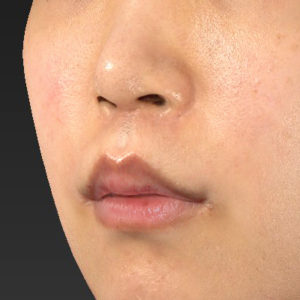 新宿ラクル美容外科クリニック　山本厚志　「人中短縮術（リップリフト）＋口角挙上（スマイルリップ）」　手術後６ヶ月目　１月１日