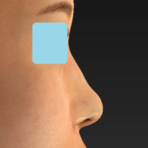 新宿ラクル美容外科クリニック　山本厚志　「鼻孔縁下降術」　手術直後　８月５日