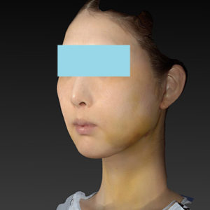 新宿ラクル美容外科クリニック　山本厚志　ナチュラルフェイスリフト　手術後１週間目　８月２０日