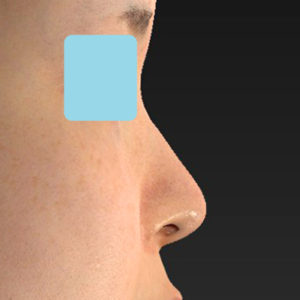 新宿ラクル美容外科クリニック　山本厚志　「小鼻縮小+α法」　手術後１２ヶ月目　１月２３日