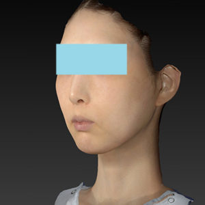 新宿ラクル美容外科クリニック　山本厚志　ナチュラルフェイスリフト　手術後１ヶ月目　８月２０日