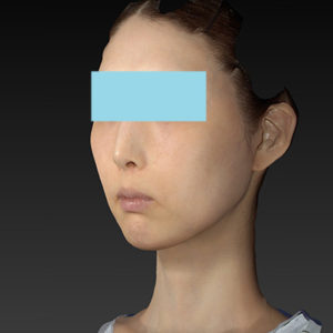 新宿ラクル美容外科クリニック　山本厚志　ナチュラルフェイスリフト　手術後２ヶ月目　８月２０日