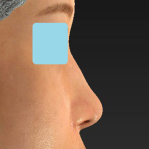 新宿ラクル美容外科クリニック　山本厚志　「鼻孔縁下降術」　手術後２ヶ月目　８月５日