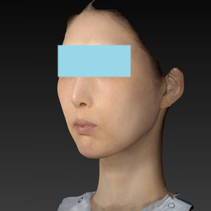 新宿ラクル美容外科クリニック　山本厚志　ナチュラルフェイスリフト　手術後３ヶ月目　８月２０日