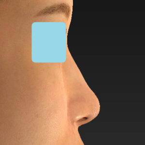 新宿ラクル美容外科クリニック　山本厚志　「鼻孔縁下降術」　手術後３ヶ月目　６月２５日