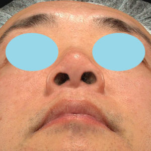 新宿ラクル美容外科クリニック　山本厚志　「小鼻縮小+α法」　手術後１２ヶ月目　３月７日