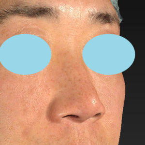 新宿ラクル美容外科クリニック　山本厚志　「小鼻縮小+α法」　手術後１２ヶ月目　３月７日