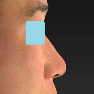 新宿ラクル美容外科クリニック　山本厚志　「小鼻縮小+α法」　手術後１２ヶ月目　３月７日