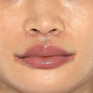 新宿ラクル美容外科クリニック　山本厚志　「人中短縮術（リップリフト）＋口角挙上（スマイルリップ）」　手術後１週間目　１０月１５日