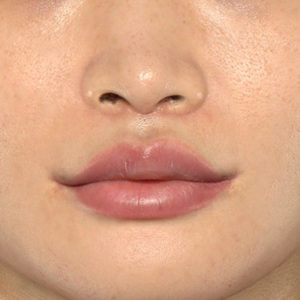 新宿ラクル美容外科クリニック　山本厚志　「人中短縮術（リップリフト）＋口角挙上（スマイルリップ）」　手術後１ヶ月目　１０月１５日