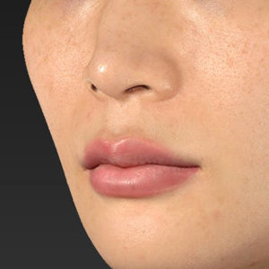 新宿ラクル美容外科クリニック　山本厚志　「人中短縮術（リップリフト）＋口角挙上（スマイルリップ）」　手術前　１０月１５日