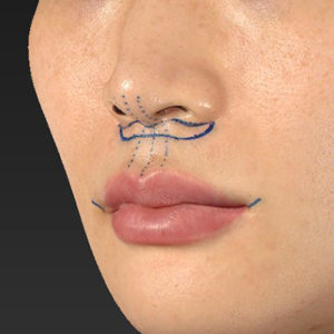 新宿ラクル美容外科クリニック　山本厚志　「人中短縮術（リップリフト）＋口角挙上（スマイルリップ）」　デザイン　１０月１５日