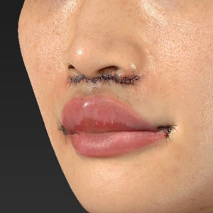 新宿ラクル美容外科クリニック　山本厚志　「人中短縮術（リップリフト）＋口角挙上（スマイルリップ）」　手術直後　１０月１５日