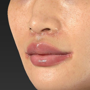 新宿ラクル美容外科クリニック　山本厚志　「人中短縮術（リップリフト）＋口角挙上（スマイルリップ）」　手術後１週間目　１０月１５日