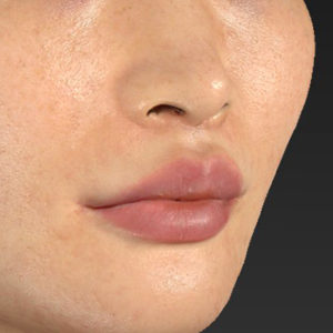 手術後2ヶ月目 新宿ラクル美容外科クリニック 山本厚志 「人中短縮術(リップリフト)+口角挙上(スマイルリップ)」 手術後2ヶ月目 11月17日
