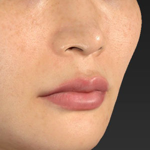 新宿ラクル美容外科クリニック　山本厚志　「人中短縮術（リップリフト）＋口角挙上（スマイルリップ）」　手術前　１０月１５日