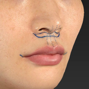 新宿ラクル美容外科クリニック　山本厚志　「人中短縮術（リップリフト）＋口角挙上（スマイルリップ）」　デザイン　１０月１５日