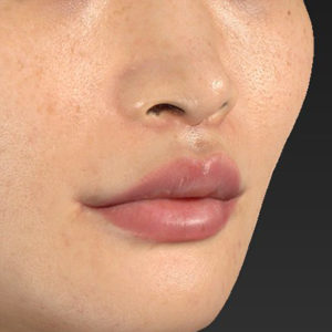 新宿ラクル美容外科クリニック　山本厚志　「人中短縮術（リップリフト）＋口角挙上（スマイルリップ）」　手術後１ヶ月目　１０月１５日