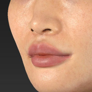 新宿ラクル美容外科クリニック　山本厚志　「人中短縮術（リップリフト）＋口角挙上（スマイルリップ）」　手術後２ヶ月目　１１月１７日