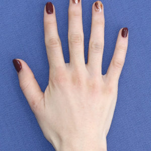 新宿ラクル美容外科クリニック　山本厚志　「手の若返り（プレミアムPRP×FGF皮膚再生療法）」　治療直後　１１月２１日